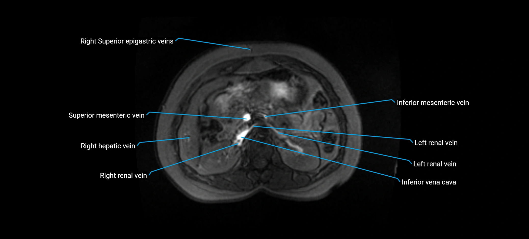 MRV abdomen pelvis & lower limb axial cross sectional anatomy labelled MRI image 61 (1).webp